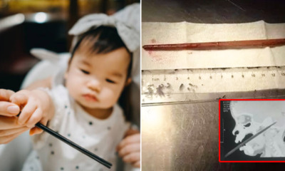 Chopstick Enters 1yo's Mouth & Pierces 2cm Into Her Brain as She - WORLD OF BUZZ