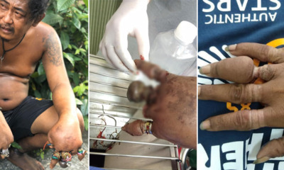 Horrifying Photos Show Dozens of Rings on - WORLD OF BUZZ