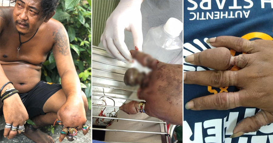 Horrifying Photos Show Dozens of Rings on - WORLD OF BUZZ