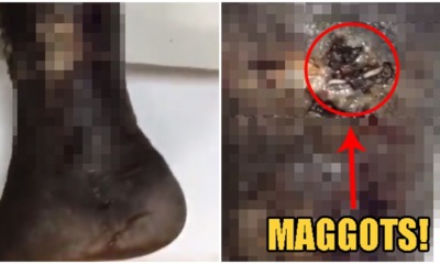 "Maggots were dropping out" Says Doctor Who Treated 47yo M'sian Diabetic With Rotting Leg - WORLD OF BUZZ