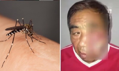 Man Suffers From Life-Threatening Infection After Scratching Mosquito Bite On His Face - WORLD OF BUZZ 3