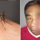 Man Suffers From Life-Threatening Infection After Scratching Mosquito Bite On His Face - WORLD OF BUZZ 3