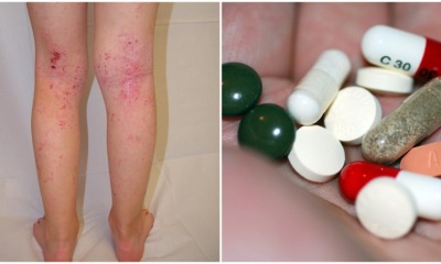No More Redness & Itchy Skin! This New Drug Could Provide FULL Relief to Eczema Symptoms! - WORLD OF BUZZ
