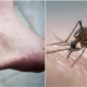 Dengue Can Now Be Transmitted Through Sex, First Case Confirm In Spain - WORLD OF BUZZ 2