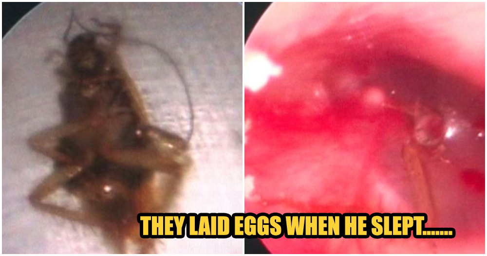 Man Had A Family Of Cockroaches In Right Ear Due To Lack Of Personal Hygiene - WORLD OF BUZZ
