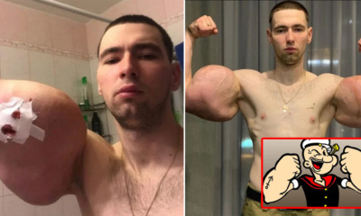 23yo Injects 3 Litres of Petroleum Jelly into Muscles to Bulk Up Biceps & Triceps Like Popeye the Sailor Man - WORLD OF BUZZ