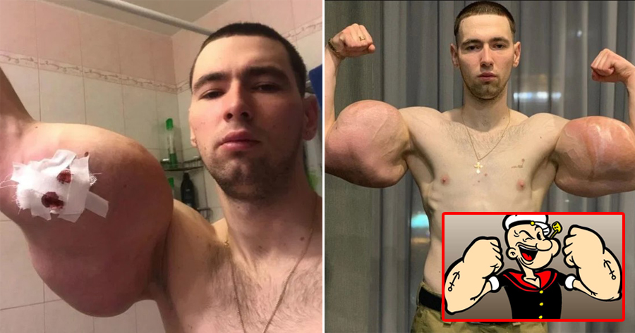 23yo Injects 3 Litres of Petroleum Jelly into Muscles to Bulk Up Biceps & Triceps Like Popeye the Sailor Man - WORLD OF BUZZ