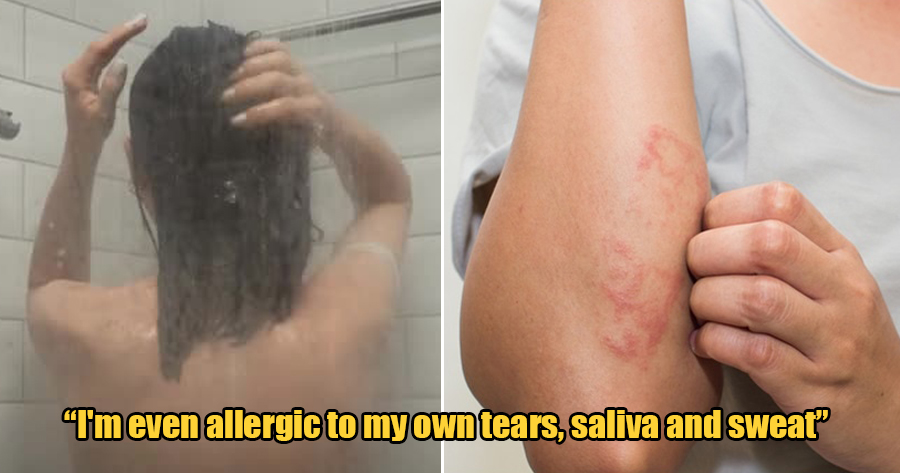 This 21yo Girl is Literally Allergic to Water & Breaks Out in Rashes and Fever if She Showers - WORLD OF BUZZ