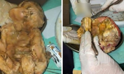 Woman Who Complained of Abdominal Pains Discovers Dead Baby That Was Inside For 15 Years - WORLD OF BUZZ