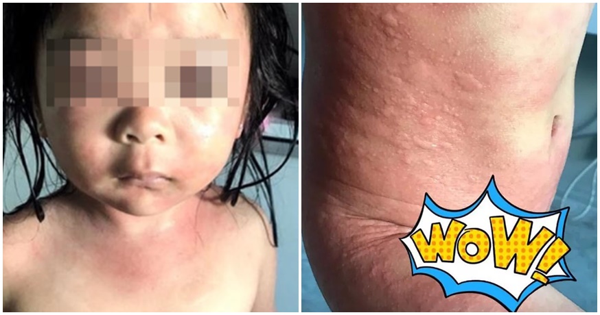 5yo Girl Suffers Painful Chlorine Burns After Swimming In Freshly Cleaned Swimming Pool - WORLD OF BUZZ