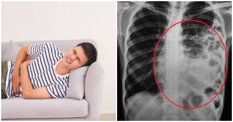 Man Undergoes Surgery After Playful Slap From GF Causes Intestines To Move Into Chest - WORLD OF BUZZ
