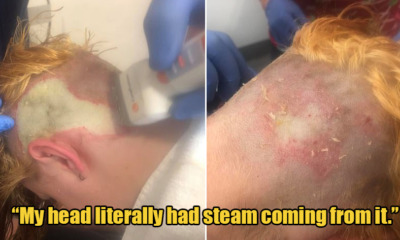 20yo Woman Suffered Third Degree Chemical Burns After Bleaching Her Own Hair to Save Money - WORLD OF BUZZ
