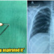 M'sian Women Had A Headscarf Pin Stuck In Her Lung - WORLD OF BUZZ 11
