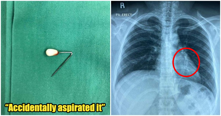 M'sian Women Had A Headscarf Pin Stuck In Her Lung - WORLD OF BUZZ 11