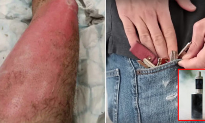 37yo Man Gets Third-Degree Burns After His Vape Rubbed Against Metal Keys In Pocket & Exploded After It Rubbed Against Metal Keys in His Pocket, - WORLD OF BUZZ