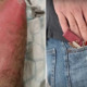 37yo Man Gets Third-Degree Burns After His Vape Rubbed Against Metal Keys In Pocket & Exploded After It Rubbed Against Metal Keys in His Pocket, - WORLD OF BUZZ