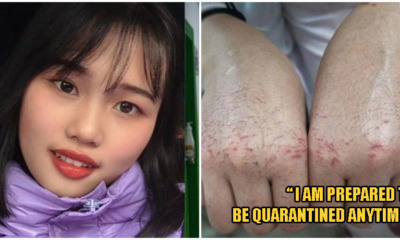 "The frontline needs me!" 22yo Nurse Endures Painful Bloodshot Hands To Treat Wuhan Patients Daily - WORLD OF BUZZ 4