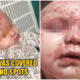 6-Month-Old Baby Gets Infected With Herpes Disease From A Kiss, Almost Leaves Her Blind In One Eye - WORLD OF BUZZ 3