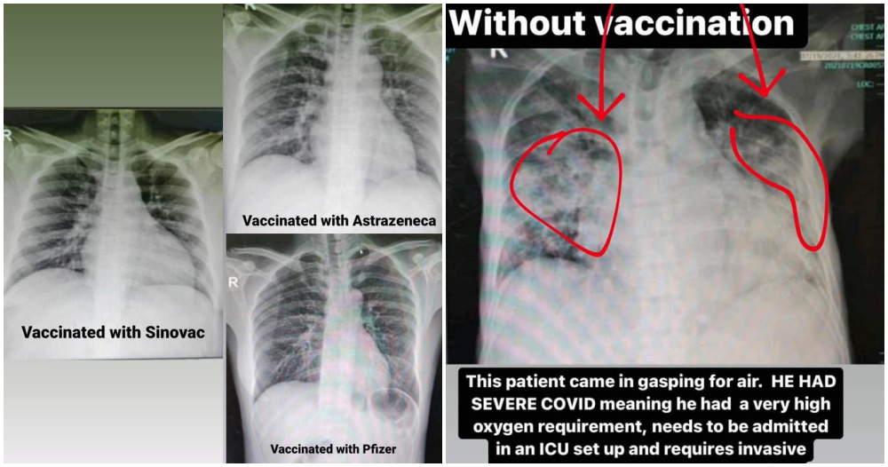 vaccine ft 1