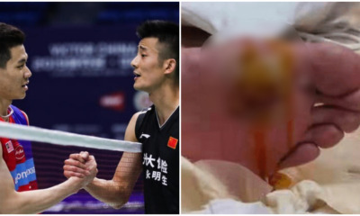 zii jia chen long blister feet ft