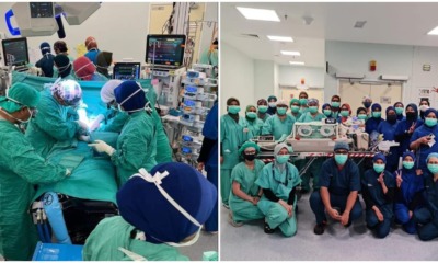 separate preemie siamese twins