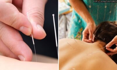 feat image acupuncture