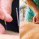 feat image acupuncture