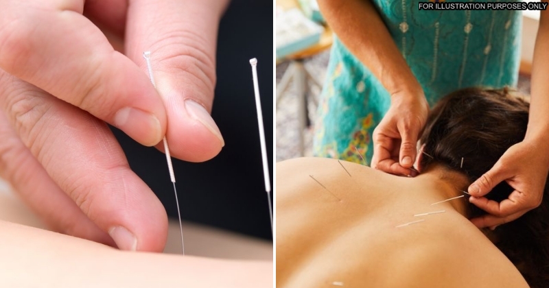 feat image acupuncture
