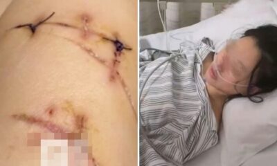 feat image breast implants