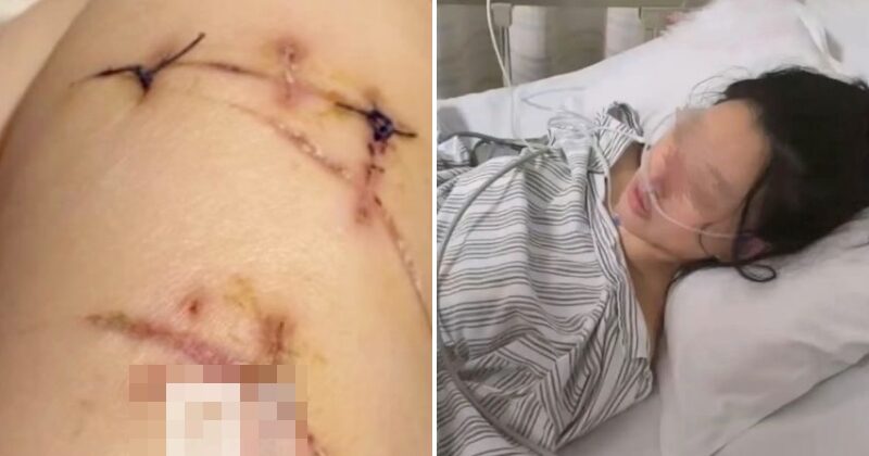 feat image breast implants